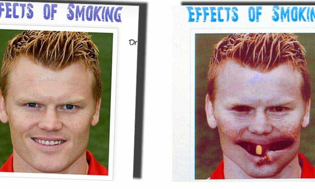 SJOKKERENDE: Sånn kan John Arne Riise ende opp hvis han røyker 40 om dagen over lang tid. Det mener en kampanje som fotballstjernen har stilt opp for. Foto: ATYC/LIVERPOOL ECHO/DAGBLADET.NO SJOKKERENDE: Sånn kan John Arne Riise ende opp hvis han røyker 40 om dagen over lang tid. Det mener en kampanje som fotballstjernen har stilt opp for. Foto: ATYC/LIVERPOOL ECHO/DAGBLADET.NO