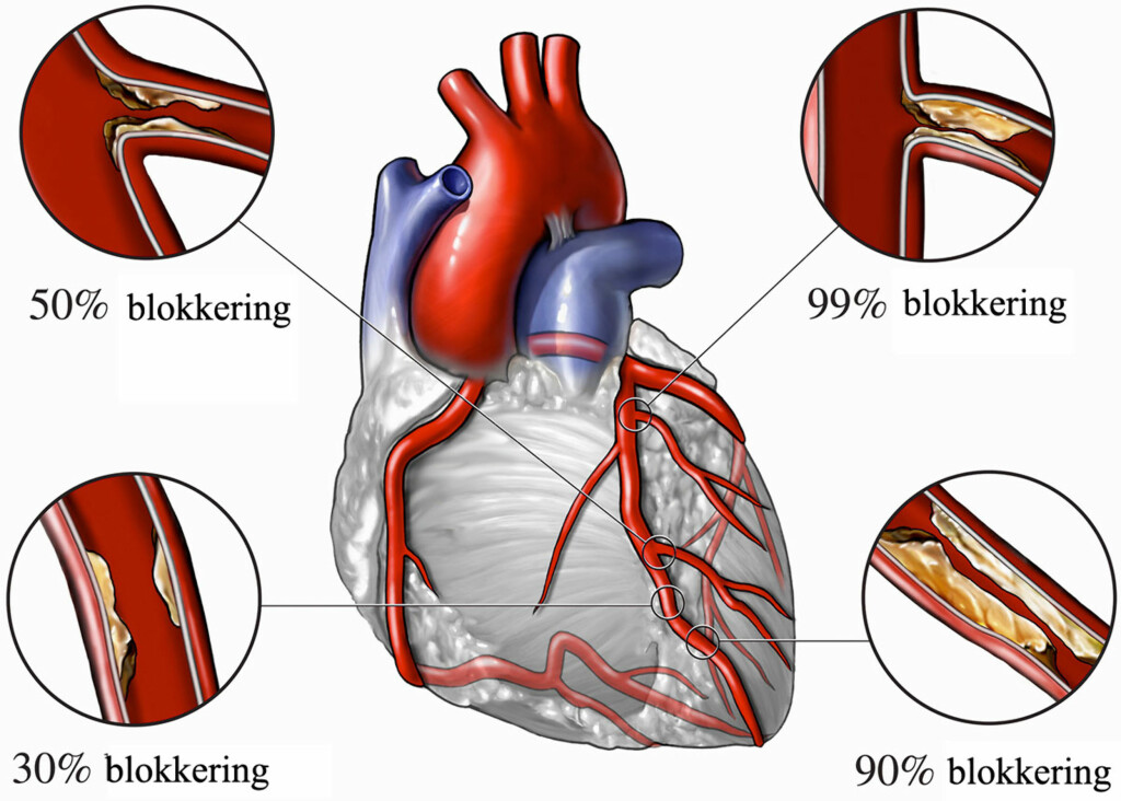 ANGINA PECTORIS: Coronarårer med arterosklerose medfører angia pectoris. Blir årene 100% blokkerte, oppstår hjerteinfarkt. Foto: NTB Scanpix / Science Photo Library ANGINA PECTORIS: Coronarårer med arterosklerose medfører angia pectoris. Blir årene 100% blokkerte, oppstår hjerteinfarkt. Foto: NTB Scanpix / Science Photo Library