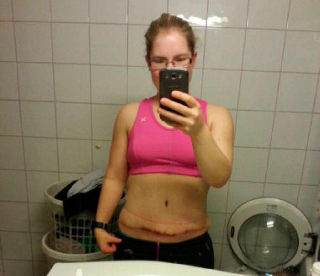MAGEN BORTE - MEN VARIG ARR: Arret er plassert som et keisersnitt, men er tre ganger så langt, og går fra hoftekam til hoftekam. Den røde streken øverst, er etter buksa, forteller Jorunn. Foto: PRIVAT MAGEN BORTE - MEN VARIG ARR: Arret er plassert som et keisersnitt, men er tre ganger så langt, og går fra hoftekam til hoftekam. Den røde streken øverst, er etter buksa, forteller Jorunn. Foto: PRIVAT