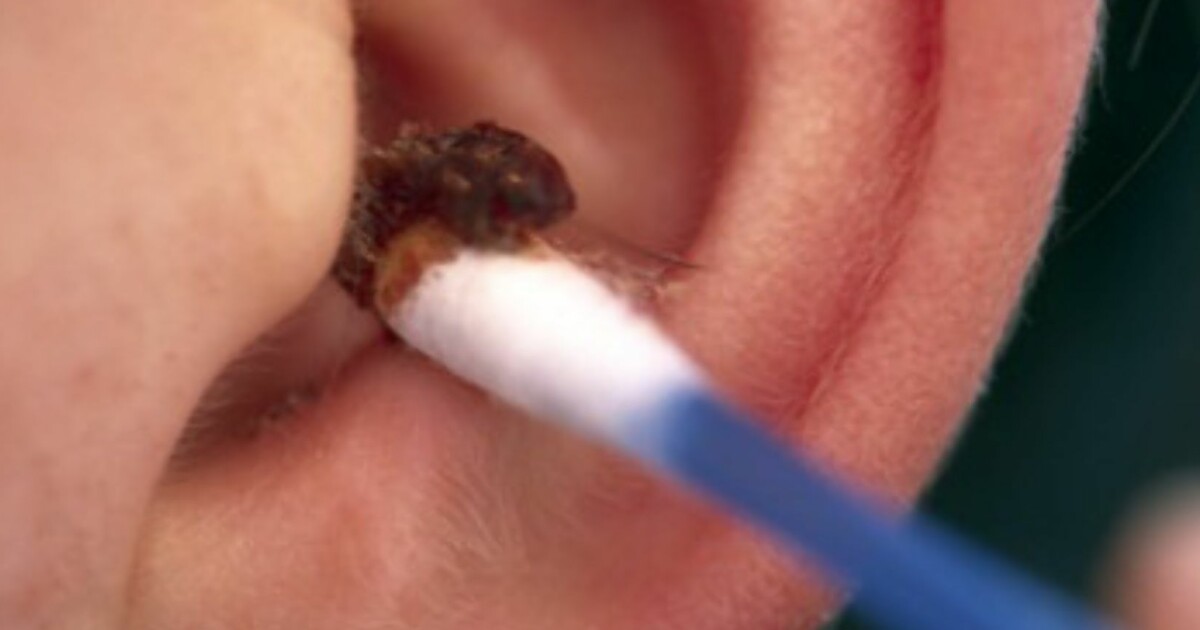 Øreskylling hjemme Øreskylling hjemme