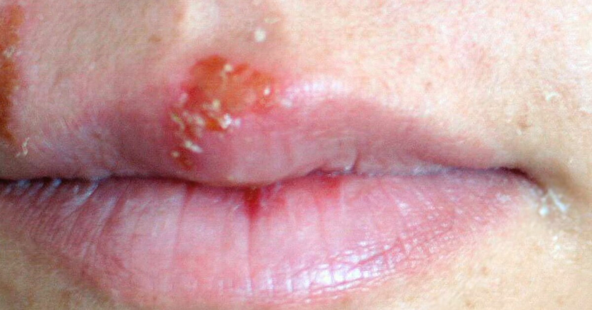 Tannkjøttbetennelse kjerringråd Tannkjøttbetennelse kjerringråd