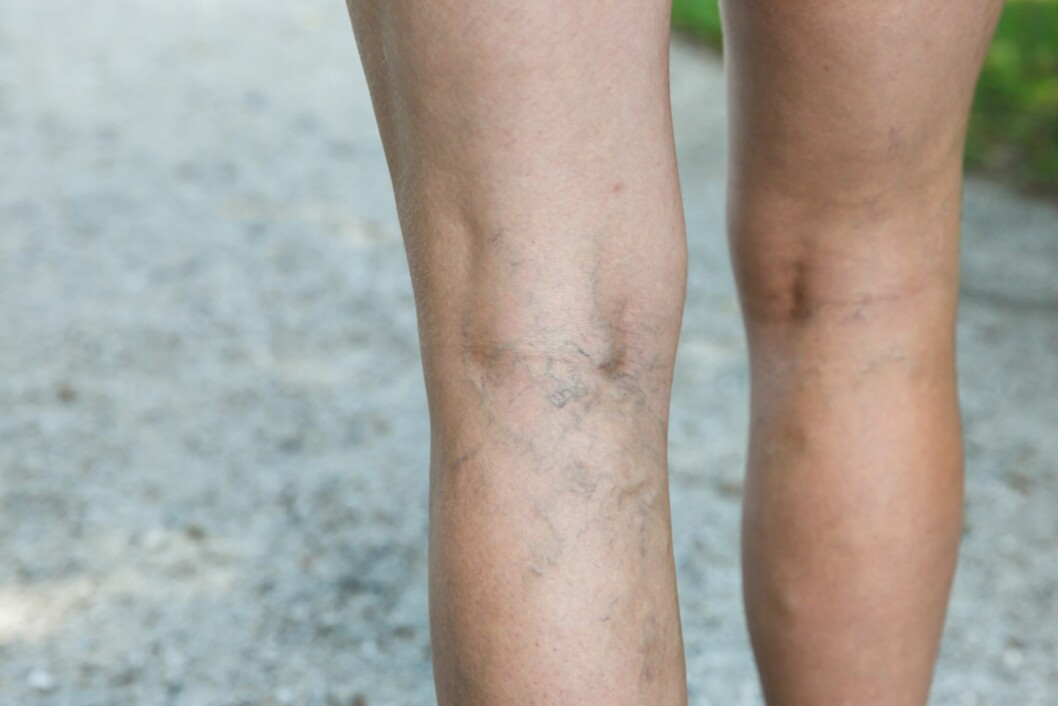 <strong>ÅREKNUTER:</strong> Åreknuter kan være plagsomt, men er ikke skadelig. Foto: NTB Scanpix <strong>ÅREKNUTER:</strong> Åreknuter kan være plagsomt, men er ikke skadelig. Foto: NTB Scanpix