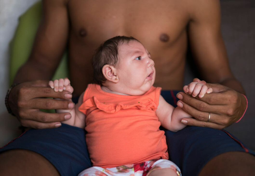 FØDT MED MIKROKEFALI: Denne babyen ble født i oktober i Brazil. Moren hadde gjennomgått zikafeber, etter et myggstikk, da hun var gravid. Foto: NTB scanpix FØDT MED MIKROKEFALI: Denne babyen ble født i oktober i Brazil. Moren hadde gjennomgått zikafeber, etter et myggstikk, da hun var gravid. Foto: NTB scanpix