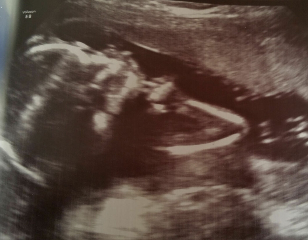 <strong>BEVISET PÅ AT DET LYKTES TIL SLUTT:</strong> Ultralydbilde av Jamie Yvonne sin baby, 20 uker. Foto: privat <strong>BEVISET PÅ AT DET LYKTES TIL SLUTT:</strong> Ultralydbilde av Jamie Yvonne sin baby, 20 uker. Foto: privat