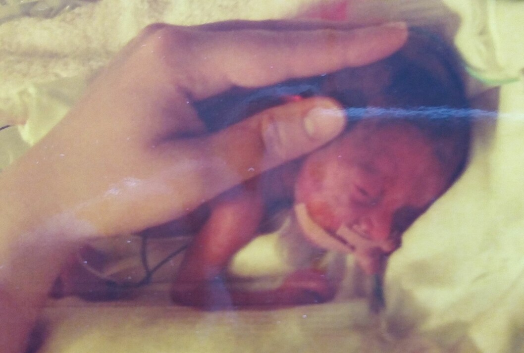 EKSTREMT LITEN: Mailin veide bare 530 gram og var 28 centimeter lang da hun ble født. Foto: Privat EKSTREMT LITEN: Mailin veide bare 530 gram og var 28 centimeter lang da hun ble født. Foto: Privat