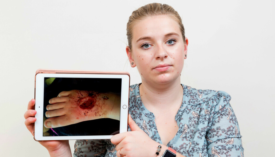 FRA VONDT TIL VERRE: Hannah ble rammet av en sjelden nevrologisk tilstand, som gir store smerter. Deretter fikk hun et sår som spiste seg innover i foten hennes. Foto: Carters FRA VONDT TIL VERRE: Hannah ble rammet av en sjelden nevrologisk tilstand, som gir store smerter. Deretter fikk hun et sår som spiste seg innover i foten hennes. Foto: Carters