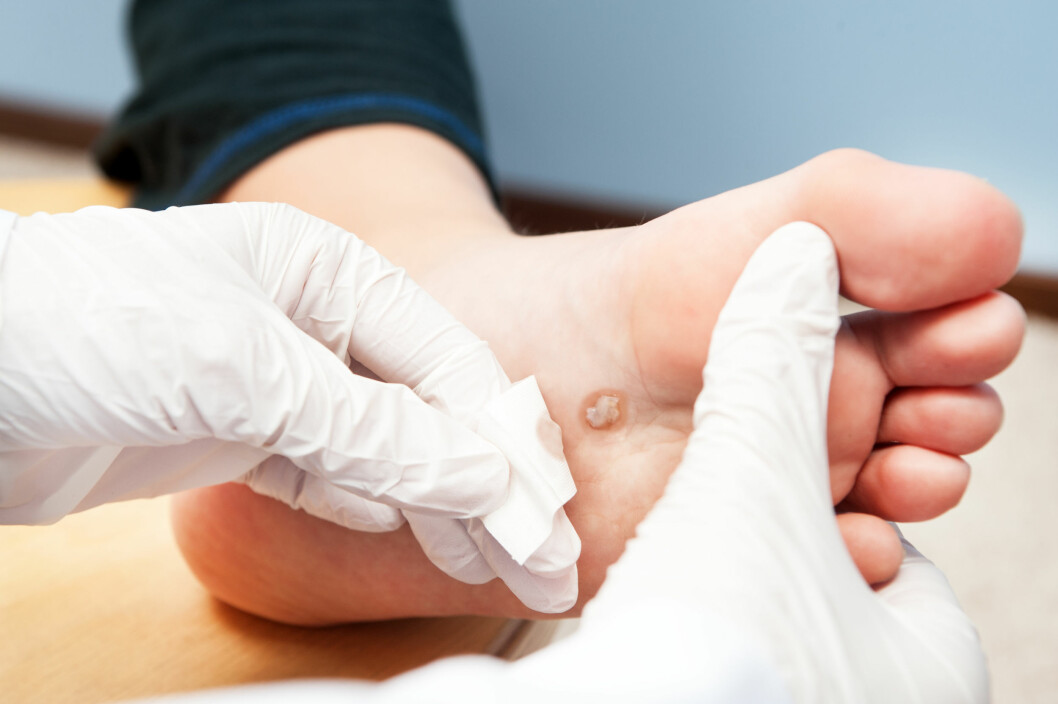 BEHANDLING AV VORTER: Dersom du vil ha hjelp til å fjerne en fotvorte kan en lege eller en fotterapeut gjøre dette for deg. Foto: Damian Gretka - Fotolia BEHANDLING AV VORTER: Dersom du vil ha hjelp til å fjerne en fotvorte kan en lege eller en fotterapeut gjøre dette for deg. Foto: Damian Gretka - Fotolia