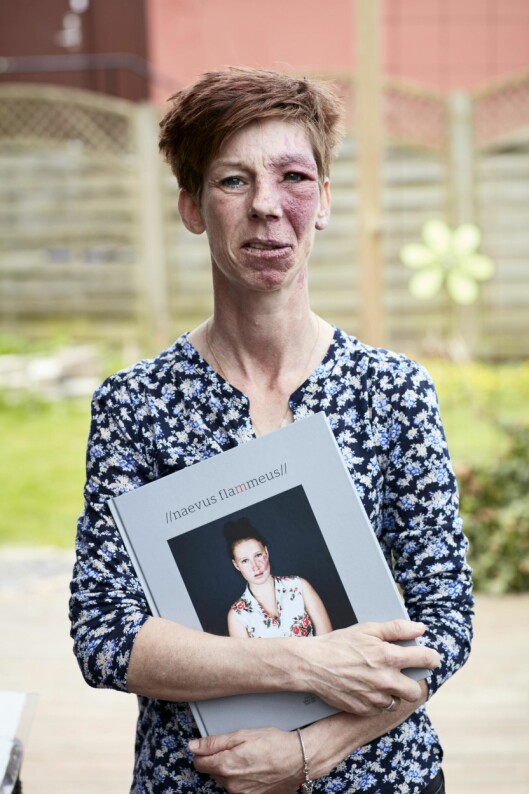 På utstilling:
I boken «Naevus flammeus» har fotografen Linda Hansen portrettert en rekke kvinner med fødsels-merke, deriblant Lisa. Fotoutstilling er det også blitt. Foto: All Over Press På utstilling:
I boken «Naevus flammeus» har fotografen Linda Hansen portrettert en rekke kvinner med fødsels-merke, deriblant Lisa. Fotoutstilling er det også blitt. Foto: All Over Press