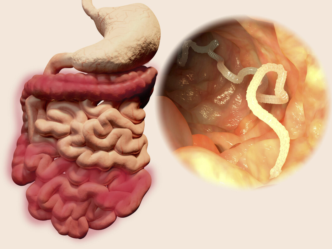 LANGVARIG: Hvis du ikke merker ormen, kan den ta bolig i kroppen din i opptil tyve år. Foto: Science Photo Library LANGVARIG: Hvis du ikke merker ormen, kan den ta bolig i kroppen din i opptil tyve år. Foto: Science Photo Library
