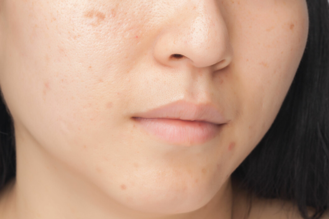 PIGMENTFLEKKER: Det er tre hovedfaktorer til at du får pigmentflekker i ansiktet: gener, UV-stråler og hormoner. Gjør noe med det du kan og beskytt deg godt i sola. Foto: phasinphoto - Fotolia PIGMENTFLEKKER: Det er tre hovedfaktorer til at du får pigmentflekker i ansiktet: gener, UV-stråler og hormoner. Gjør noe med det du kan og beskytt deg godt i sola. Foto: phasinphoto - Fotolia