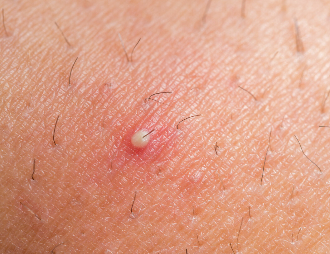 KVISELIGNENDE NUPPER: Dersom du er plaget med kviselignende nupper bør du ta en pause fra barberingen. Foto: F.C.G. - Fotolia KVISELIGNENDE NUPPER: Dersom du er plaget med kviselignende nupper bør du ta en pause fra barberingen. Foto: F.C.G. - Fotolia