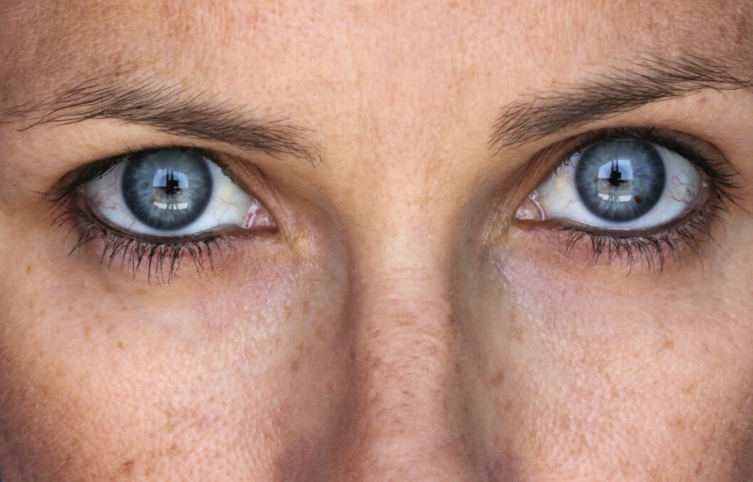 PIGMENTERING: – Pigmentet i huden øker drastisk parallelt med den økningen i hormoner som finner sted ved graviditet. 70 prosent av alle gravide opplever pigmentering i forbindelse med svangerskapet, såkalt melasma, sier Ann-Kristin Stokke i Skintific. PIGMENTERING: – Pigmentet i huden øker drastisk parallelt med den økningen i hormoner som finner sted ved graviditet. 70 prosent av alle gravide opplever pigmentering i forbindelse med svangerskapet, såkalt melasma, sier Ann-Kristin Stokke i Skintific.