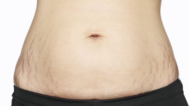 Strekkmerker vektnedgang Strekkmerker vektnedgang