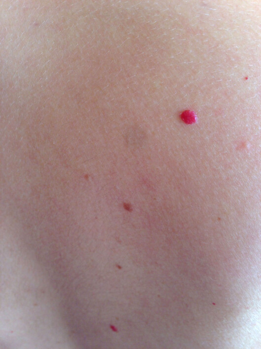 PLAGSOMME? Da kan de fjernes. Hudlegen kan fjerne opptil 50 angiomer på én behandling. Foto: KK.no PLAGSOMME? Da kan de fjernes. Hudlegen kan fjerne opptil 50 angiomer på én behandling. Foto: KK.no