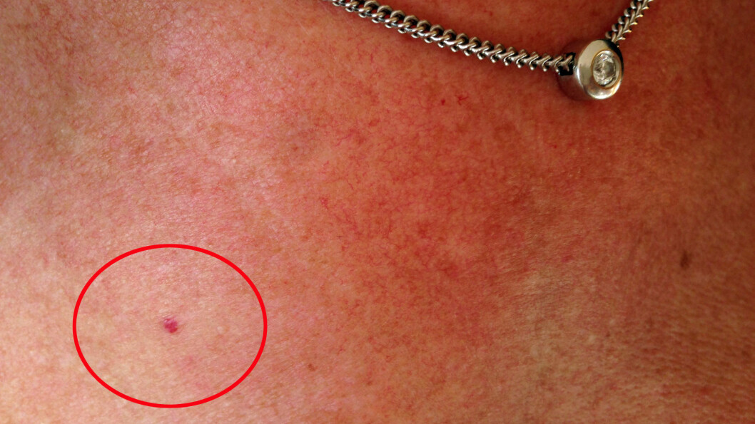 Har du røde prikker på huden?