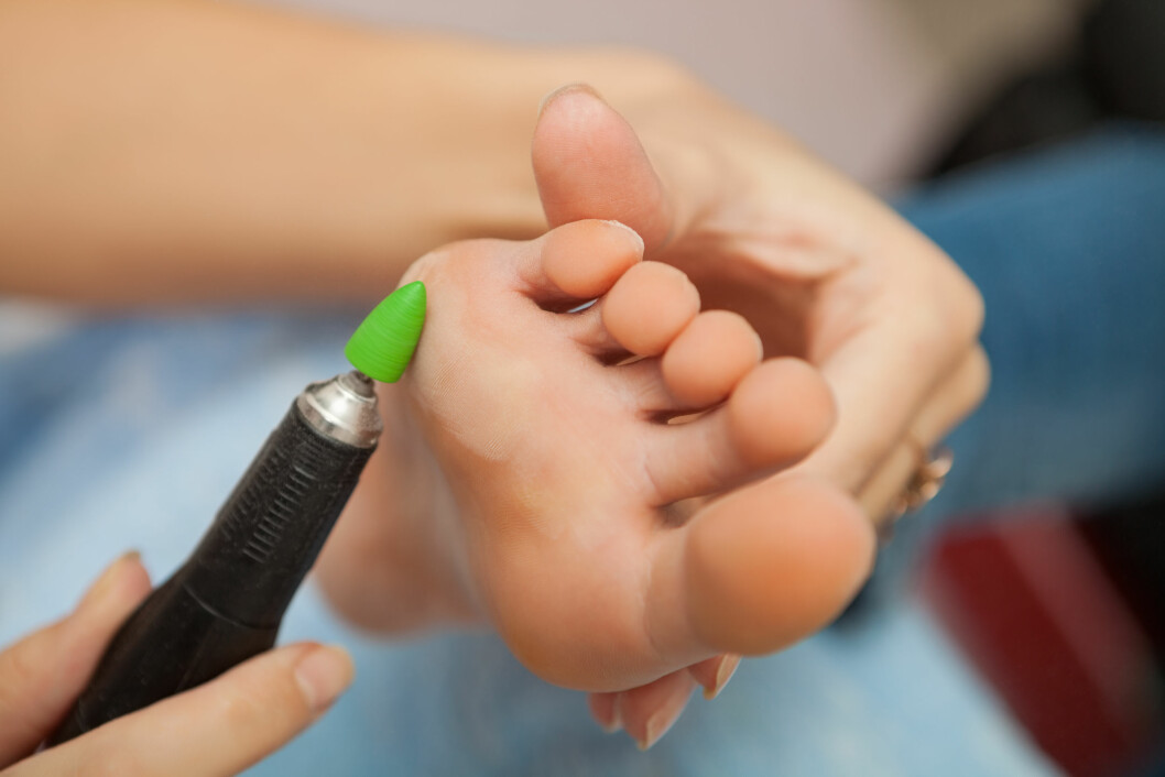 SKOEN TRYKKER: Treller på føttene er ikke bare kjipt i sommersandalene, det er som regel også et tegn på at skoen trykker et sted. Foto: AlexOakenman - Fotolia SKOEN TRYKKER: Treller på føttene er ikke bare kjipt i sommersandalene, det er som regel også et tegn på at skoen trykker et sted. Foto: AlexOakenman - Fotolia