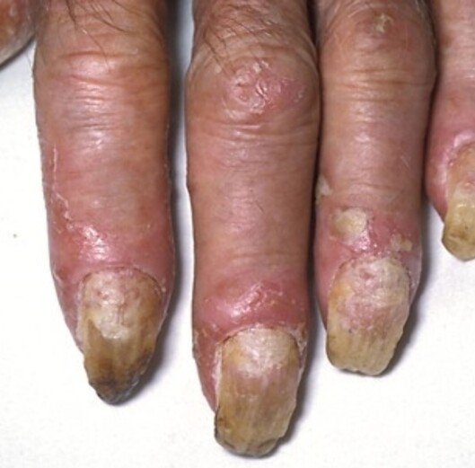 Ruglete negler kan være tegn på psoriasis. Foto: Science Photo Library Ruglete negler kan være tegn på psoriasis. Foto: Science Photo Library