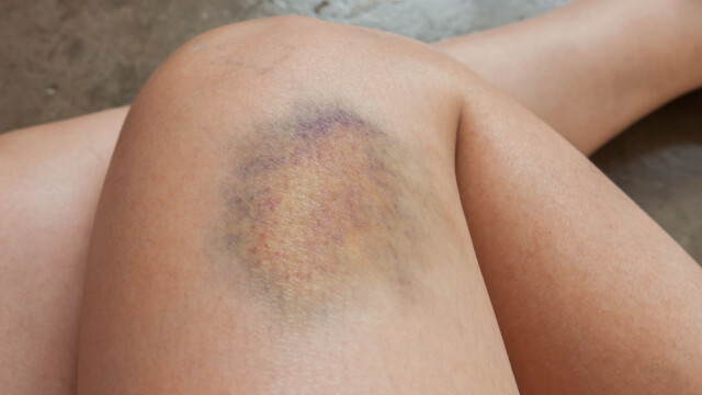 Blodutredelse lår Blodutredelse lår