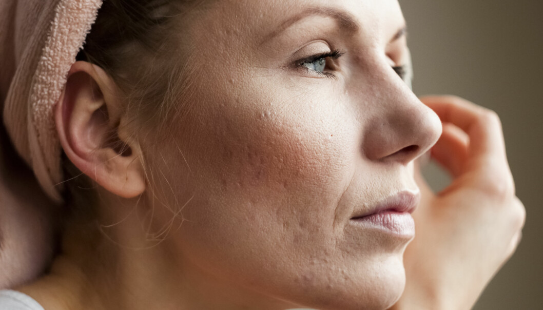 AKNEARR: Arrene kan ikke fjernes helt, men de kan helt klart gjøres mindre synlige. FOTO: NTB Scanpix AKNEARR: Arrene kan ikke fjernes helt, men de kan helt klart gjøres mindre synlige. FOTO: NTB Scanpix