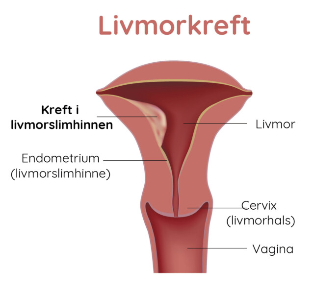 Underlivskreft symptom Underlivskreft symptom