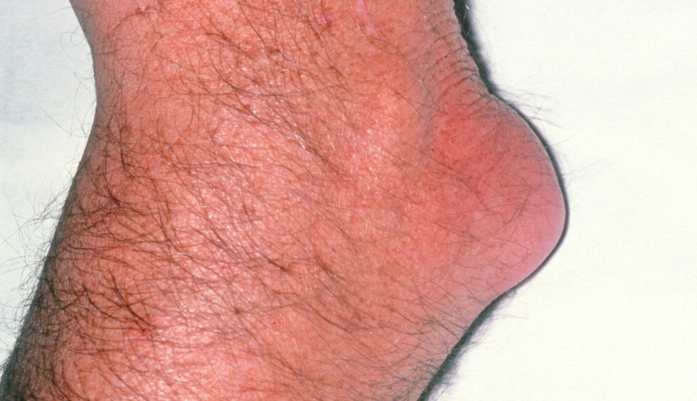 Bursitt: Betennelse i leddets slimpose - Lommelegen