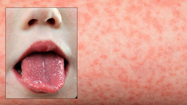 Halsbetennelse smittsomt Halsbetennelse smittsomt