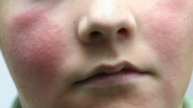 Den fjerde barnesykdom feber Den fjerde barnesykdom feber