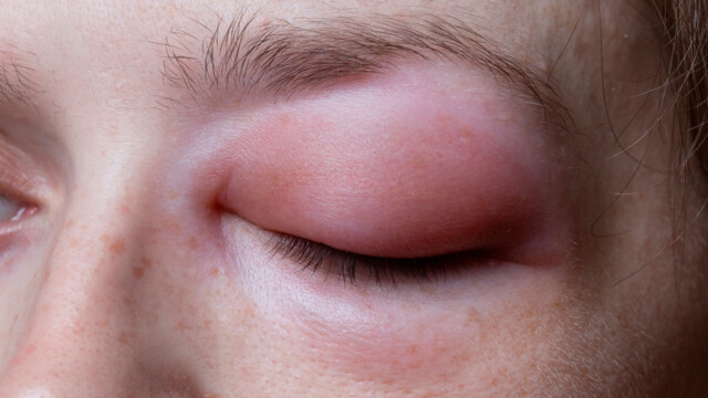 Baby rød rundt øynene trøtt Baby rød rundt øynene trøtt