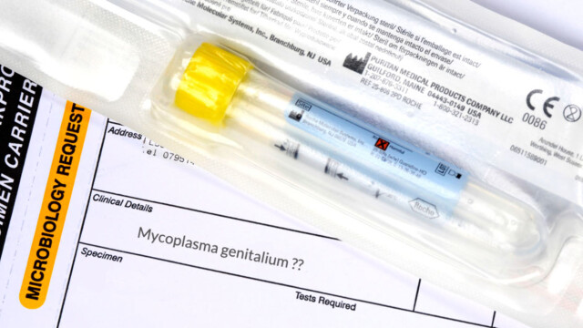 Kjønnssykdommer test urinprøve Kjønnssykdommer test urinprøve