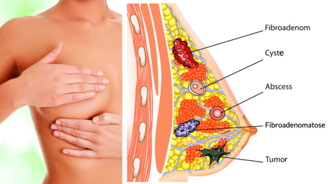 Væske fra brystene overgangsalder