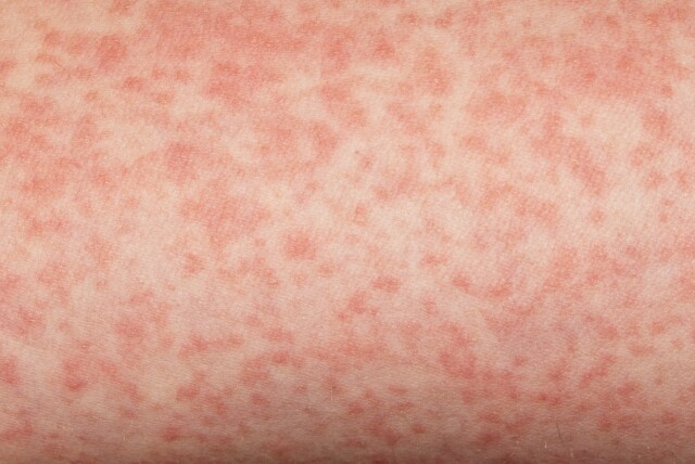 Utslett innside lår Utslett innside lår