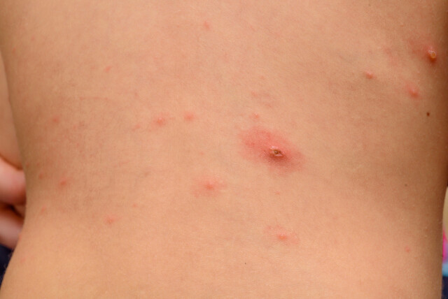 Starten på vannkopper Starten på vannkopper