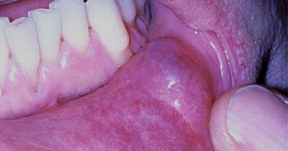 Byll i munnen Byll i munnen