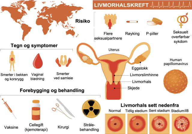 Livmorhalskreft stadier Livmorhalskreft stadier