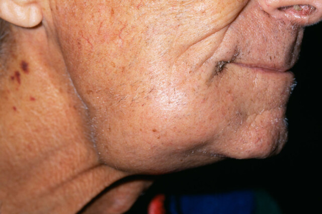 Lymfekreft blodprøver Lymfekreft blodprøver