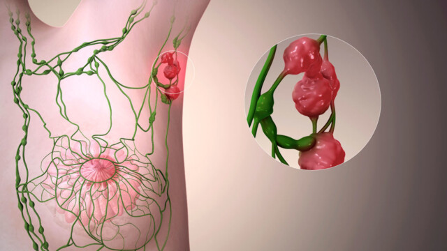 Lymfekreft blodprøver Lymfekreft blodprøver