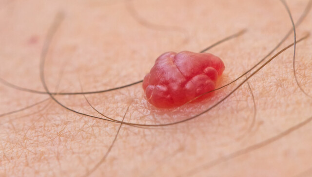 Senile petekkier Senile petekkier