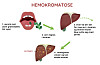 Hemokromatose: Har Du For Mye Jern I Kroppen? - Lommelegen