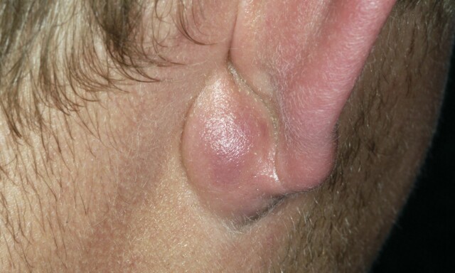 Betent talgkjertel i underlivet Betent talgkjertel i underlivet