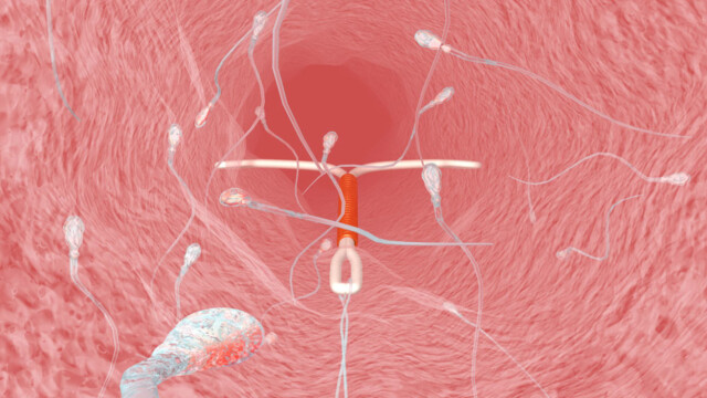 Symptomer på at spiralen sitter feil Symptomer på at spiralen sitter feil