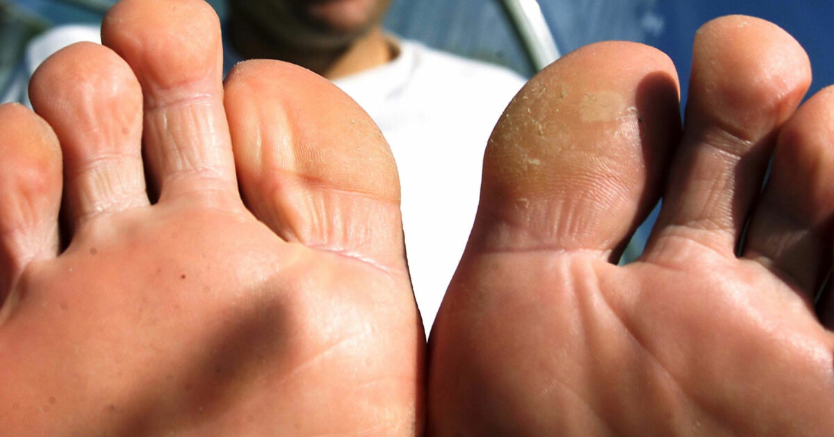 Hånd fot og munnsykdom mister negler Hånd fot og munnsykdom mister negler