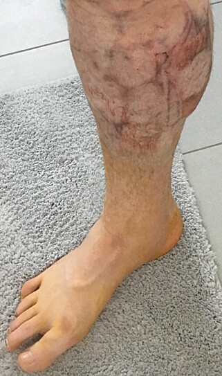 GA BLAFFEN I LEGENS RÅD: Dermed ble Frank Løkes legg seende slik ut. Foto: Frank Løke GA BLAFFEN I LEGENS RÅD: Dermed ble Frank Løkes legg seende slik ut. Foto: Frank Løke