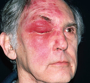 Vannkopper inkubasjonstid Vannkopper inkubasjonstid