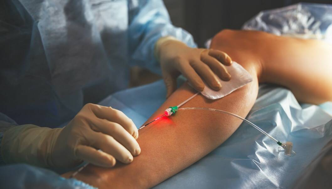 LASER: Det finnes flere typer behandlinger mot åreknuter, og laser er et godt alternativ. FOTO: NTB Scanpix LASER: Det finnes flere typer behandlinger mot åreknuter, og laser er et godt alternativ. FOTO: NTB Scanpix