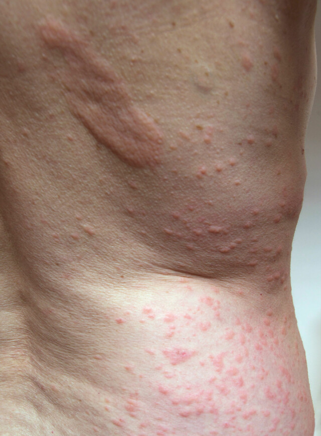 Mild soleksem Mild soleksem