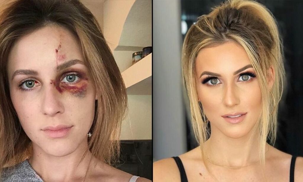 image: Melissas bilder av skadene gikk verden rundt. Nå blir hun saksøkt av kjæresten