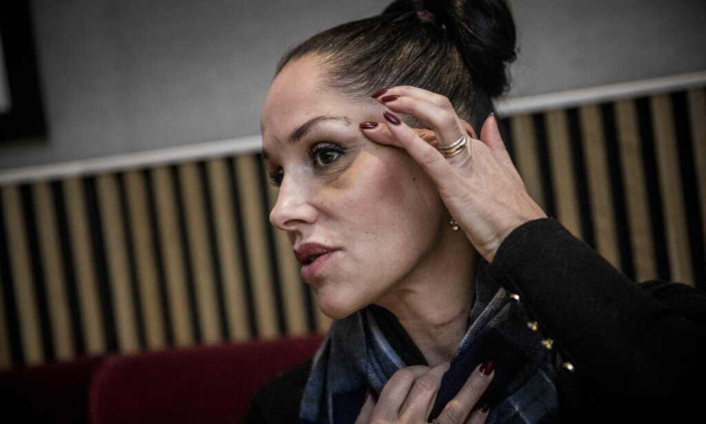 MÅTTE SY: Salvesen er merket etter nål og tråd og har merker på halsen etter hendelsen. Foto: Christian Roth Christensen / Dagbladet MÅTTE SY: Salvesen er merket etter nål og tråd og har merker på halsen etter hendelsen. Foto: Christian Roth Christensen / Dagbladet