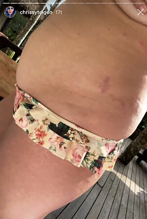 STREKKMERKER: Chrissy Teigen viste frem strekkmerkene sine på Instagram for følgerne sine. Foto: Instagram, skjermdump STREKKMERKER: Chrissy Teigen viste frem strekkmerkene sine på Instagram for følgerne sine. Foto: Instagram, skjermdump