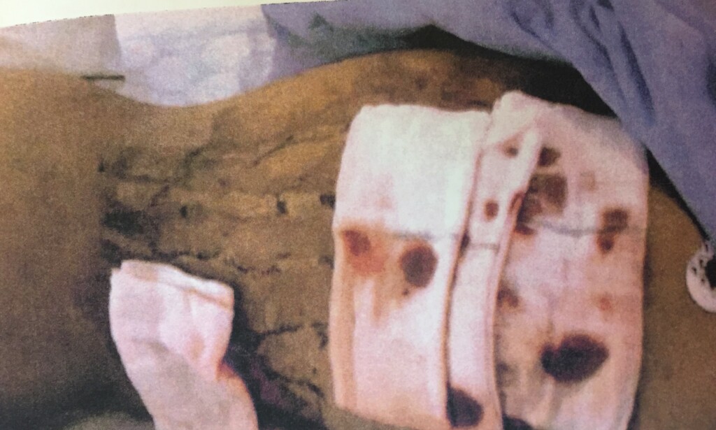 SKADET: Her er 25-åringens rygg etter at han ble flådd på en fest i fjor. Foto: Politiet SKADET: Her er 25-åringens rygg etter at han ble flådd på en fest i fjor. Foto: Politiet
