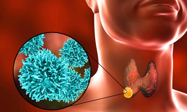 diabetes sintomática de skjelett kreft